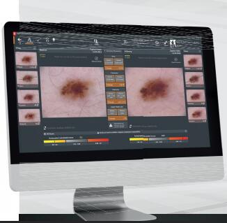 恩泰 數字皮膚鏡 FotoFinder bodystudio ATBM